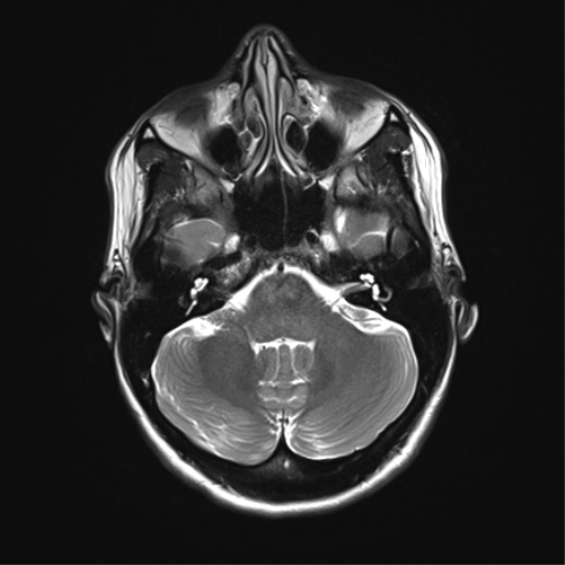 File:Anaplastic astrocytoma IDH mutant (Radiopaedia 50046-55341 Axial T2 10).png