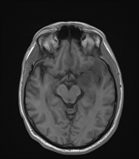 Anaplastic astrocytoma IDH wild-type (Radiopaedia 49984-55273 Axial T1 25).png