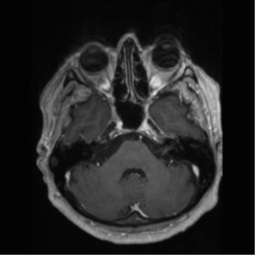 File:Anaplastic astrocytoma IDH wild-type (pseudoprogression) (Radiopaedia 42209-45277 Axial T1 C+ 29).png