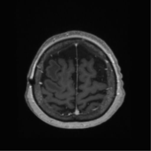 File:Anaplastic astrocytoma IDH wild-type (pseudoprogression) (Radiopaedia 42209-45278 Axial T1 C+ 129).png