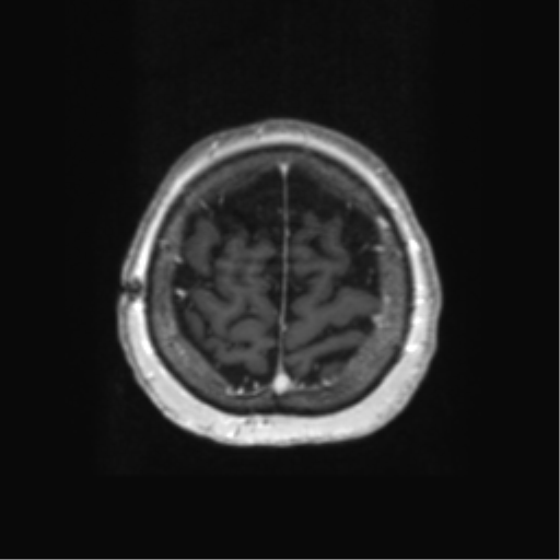 Anaplastic astrocytoma IDH wild-type (pseudoprogression) (Radiopaedia 42209-45279 Axial T1 C+ 123).png