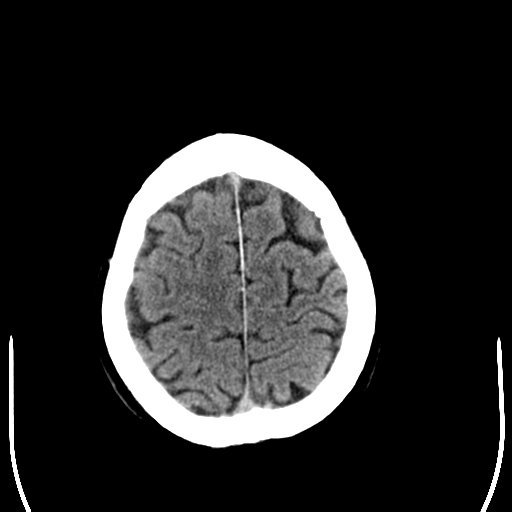 File:Anaplastic meningioma with recurrence (Radiopaedia 34452-35781 Axial non-contrast 28).png