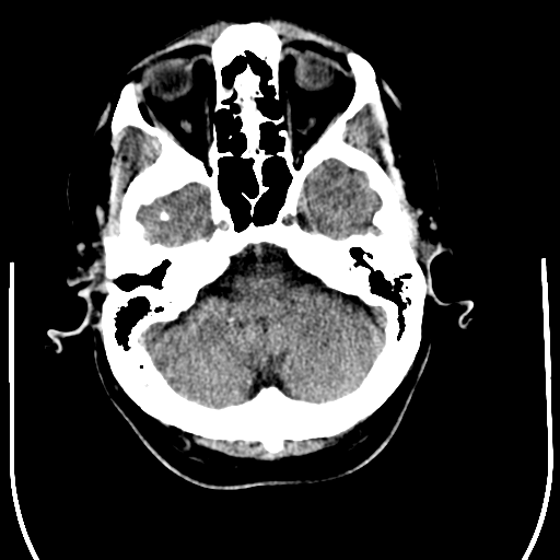 File:Anaplastic meningioma with recurrence (Radiopaedia 34452-35781 Axial non-contrast 7).png