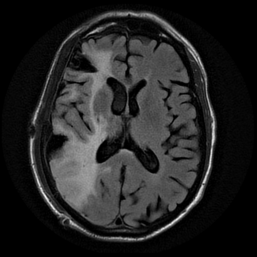 File:Anaplastic meningioma with recurrence (Radiopaedia 34452-35791 Axial FLAIR 12).png