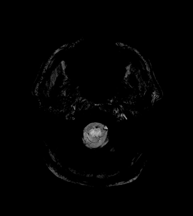 Anaplastic oligodendroglioma (Radiopaedia 79571-92754 F 8).jpg