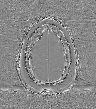 Anaplastic oligodendroglioma (Radiopaedia 83500-98599 Axial SWI - phase 77).png