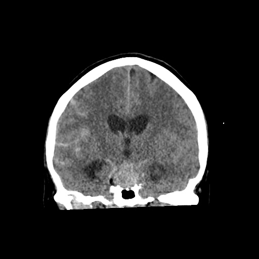 Aneursym related subarachnoid hemorrhage with hydrocephalus (Radiopaedia 45105-49083 Coronal non-contrast 32).jpg