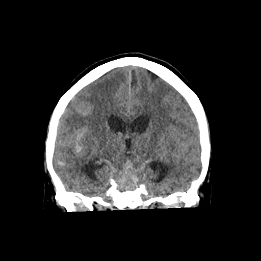 Aneursym related subarachnoid hemorrhage with hydrocephalus (Radiopaedia 45105-49083 Coronal non-contrast 33).jpg