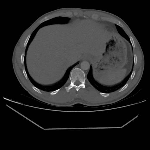 File:Aneurysmal bone cyst - rib (Radiopaedia 82167-96220 Axial bone window 213).jpg