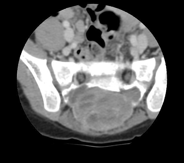 Aneurysmal bone cyst - sacrum (Radiopaedia 65190-74195 Axial non-contrast 22).jpg