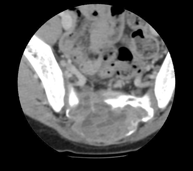 Aneurysmal bone cyst - sacrum (Radiopaedia 65190-74195 Axial non-contrast 29).jpg