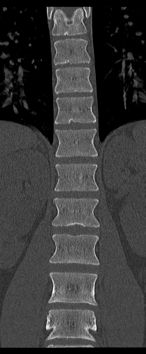Aneurysmal bone cyst T11 (Radiopaedia 29294-29721 Coronal bone window 28).jpg