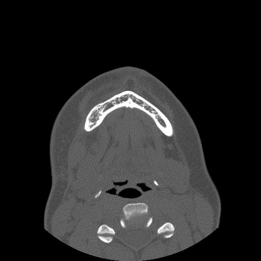 Aneurysmal bone cyst of the mandible (Radiopaedia 43280-46823 Axial bone window 23).jpg