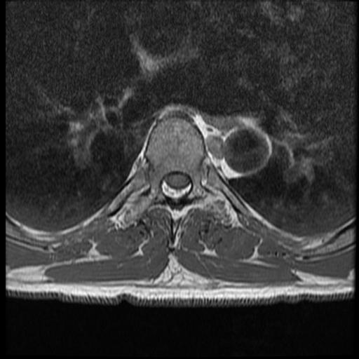 File:Angiolipoma - thoracic spine (Radiopaedia 28242-28479 Axial T1 8).jpg