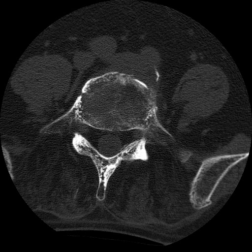 Ankylosing spondylitis complicated by fracture-dislocation (Radiopaedia 33583-34674 Axial non-contrast 128).jpg