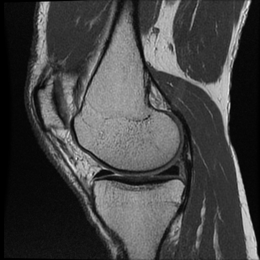 Anomalous insertion of the medial meniscus (Radiopaedia 77559-89721 Sagittal PD 36).jpg