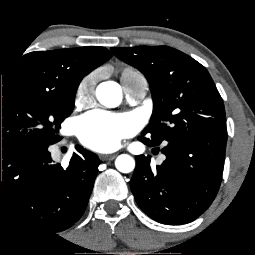 Anomalous left coronary artery from the pulmonary artery (ALCAPA) (Radiopaedia 70148-80181 A 85).jpg