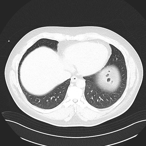 File:Anomalous origin of the left coronary artery with malignant course (Radiopaedia 77842-90126 Axial lung window 26).jpeg
