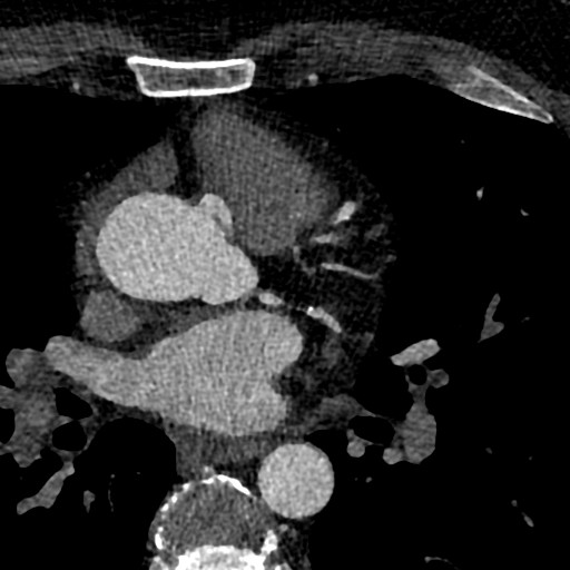 File:Anomalous origin of the left coronary artery with malignant course (Radiopaedia 77842-90126 C 38).jpeg
