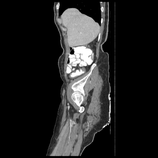 Anorectal carcinoma (Radiopaedia 44413-48064 C 11).jpg