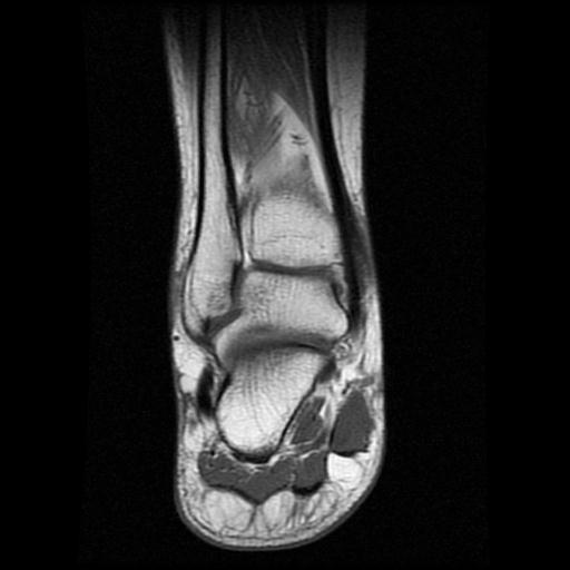 File:Anterior calcaneal process fracture (Radiopaedia 71377-81705 Coronal T1 10).jpg