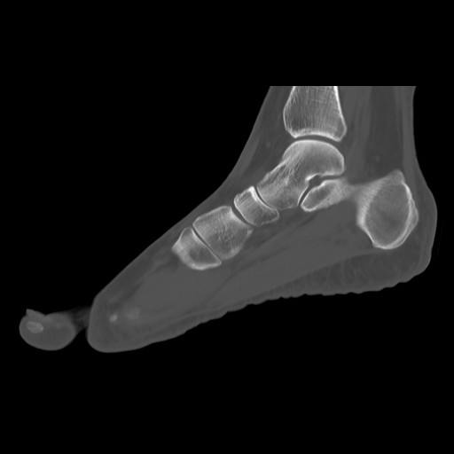 File:Anterior calcaneal process fracture (Radiopaedia 82590-96762 Sagittal bone window 11).jpg
