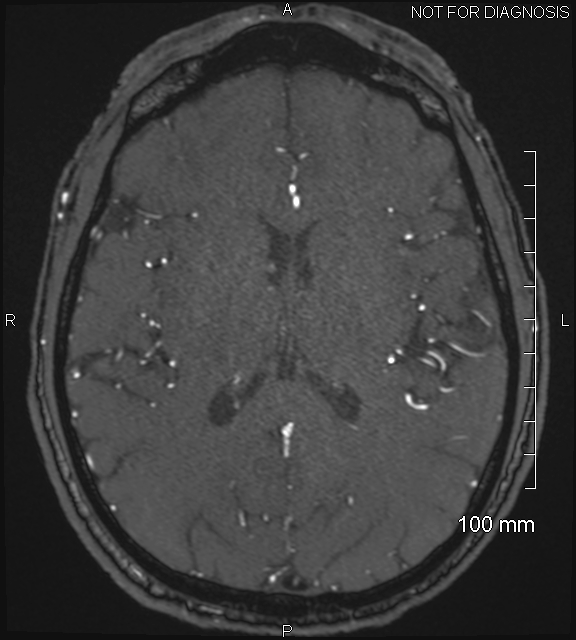 Anterior cerebral artery aneurysm (Radiopaedia 80683-94127 Axial MRA 141).jpg