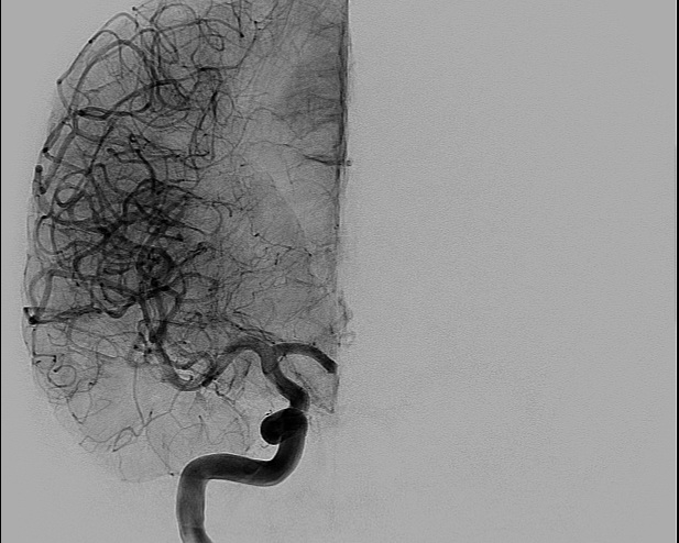 File:Anterior cerebral artery aneurysm (Radiopaedia 80683-94128 A 5).jpg