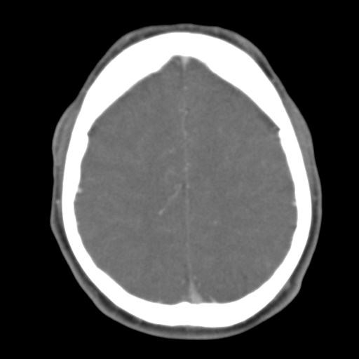 File:Anterior cerebral artery territory infarct (Radiopaedia 39327-41581 B 18).png