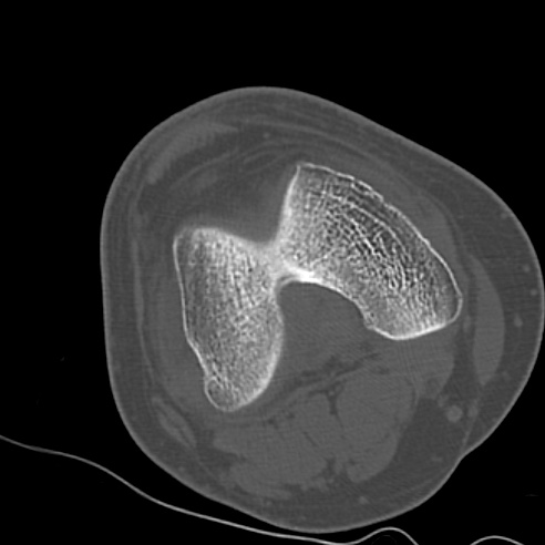 File:Anterior cruciate ligament avulsion fracture (Radiopaedia 58939-66194 Axial bone window 10).jpg