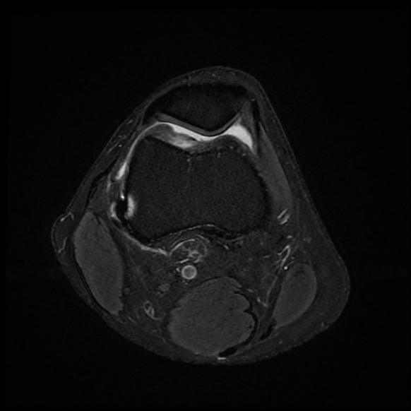 File:Anterior cruciate ligament graft tear and bucket-handle tear of medial meniscus (Radiopaedia 75867-87254 Axial PD fat sat 22).jpg