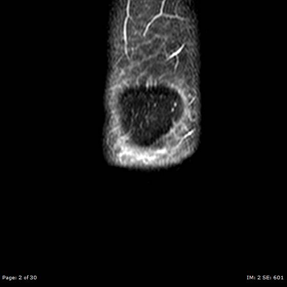 File:Anterior cruciate ligament tear (Radiopaedia 70783-80964 Coronal STIR 2).jpg