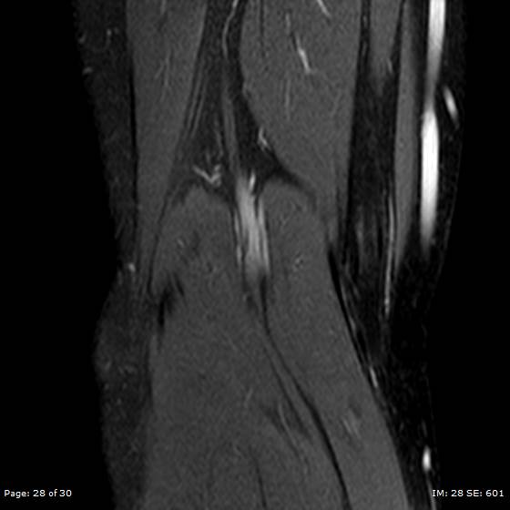 File:Anterior cruciate ligament tear (Radiopaedia 70783-80964 Coronal STIR 28).jpg