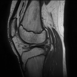 Anterior cruciate ligament tear - pediatric (Radiopaedia 62152-70260 Sagittal PD 107).jpg