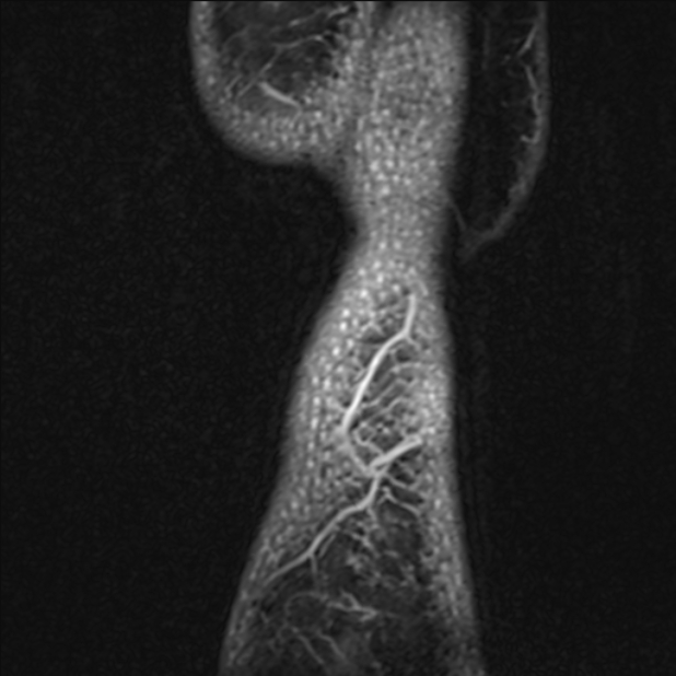 Anterior cruciate ligament tear - ramp lesion (Radiopaedia 71883-82322 Sagittal T1 vibe 2).jpg