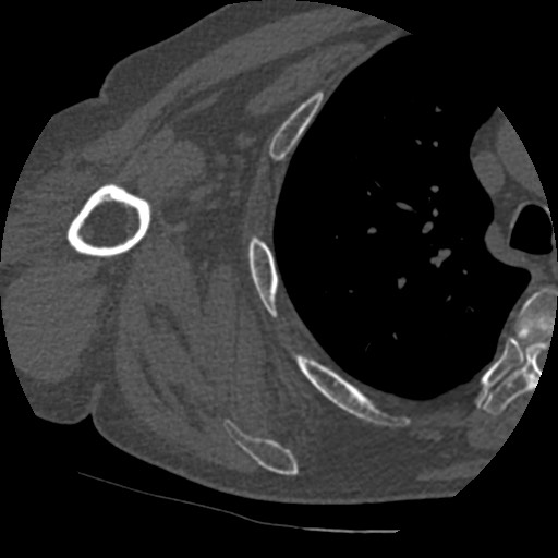 File:Anterior glenohumeral dislocation with Hill-Sachs lesion (Radiopaedia 62877-71249 Axial bone window 71).jpg