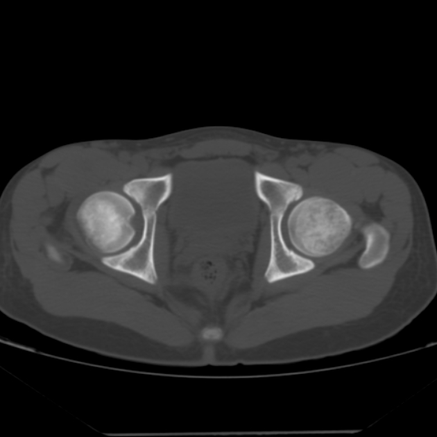 Anterior inferior iliac spine avulsion fracture (Radiopaedia 49469-54627 Axial bone window 42).jpg