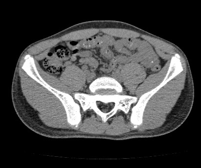 Anterior inferior iliac spine avulsion fracture (Radiopaedia 81312-94999 Axial non-contrast 24).jpg