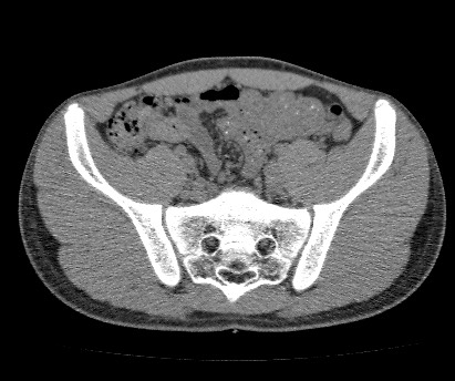 File:Anterior inferior iliac spine avulsion fracture (Radiopaedia 81312-94999 Axial non-contrast 30).jpg