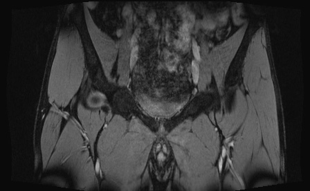 Anterior inferior iliac spine avulsion fracture (Radiopaedia 81312-95000 G 70).jpg