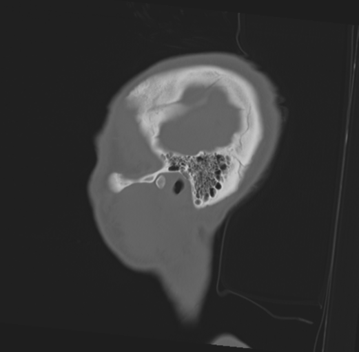 Anterior nasal spine fracture (Radiopaedia 46138-50494 Sagittal bone window 9).png