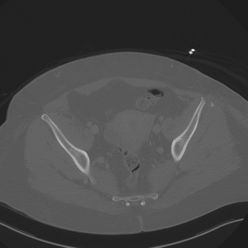 Anterior superior iliac spine avulsion fracture (Radiopaedia 44541-48244 Axial bone window 84).png