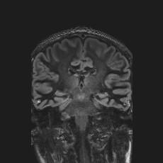 Anterior temporal encephalocele (Radiopaedia 82624-96808 Coronal FLAIR 30).jpg