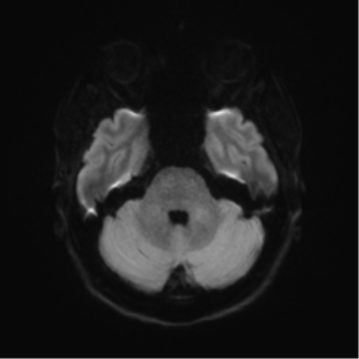File:Anterior temporal lobe perivascular space (Radiopaedia 40946-43650 Axial DWI 34).png