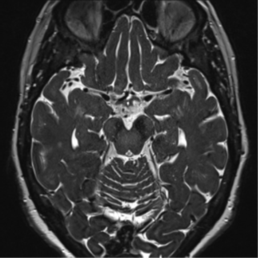Anterior temporal pole cysts (Radiopaedia 46629-51102 Axial 49).png