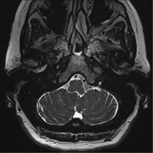 Anterior temporal pole cysts (Radiopaedia 46629-51102 Axial T2 12).png