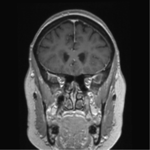 Anterior temporal pole cysts (Radiopaedia 46629-51102 Coronal T1 C+ 124).png