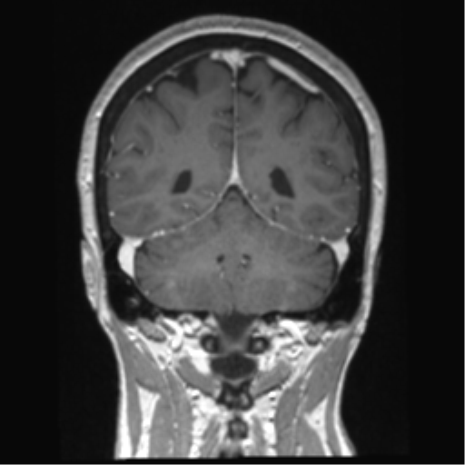 Anterior temporal pole cysts (Radiopaedia 46629-51102 Coronal T1 C+ 51).png