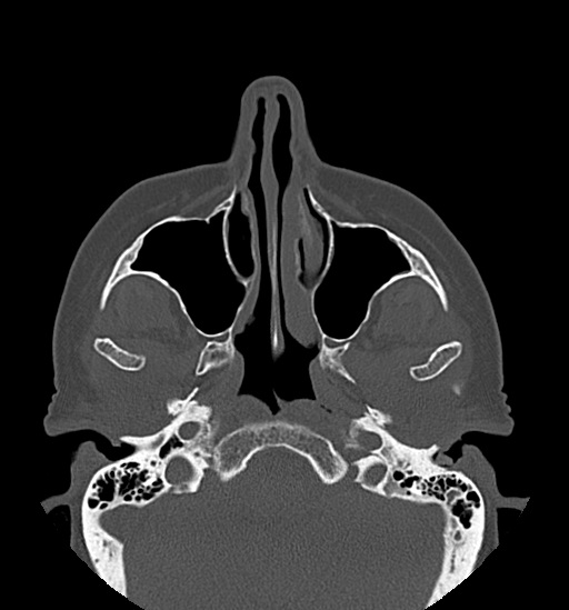 Anterior temporomandibular joint dislocation (Radiopaedia 59430-66784 Axial non-contrast 16).jpg