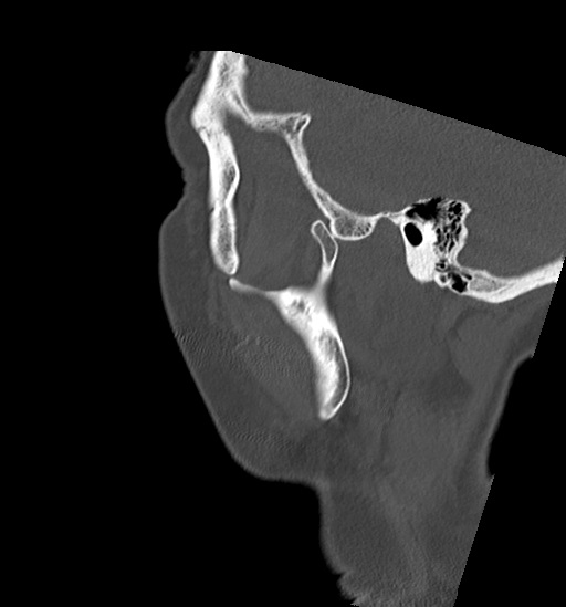 Anterior temporomandibular joint dislocation (Radiopaedia 59430-66784 B 55).jpg